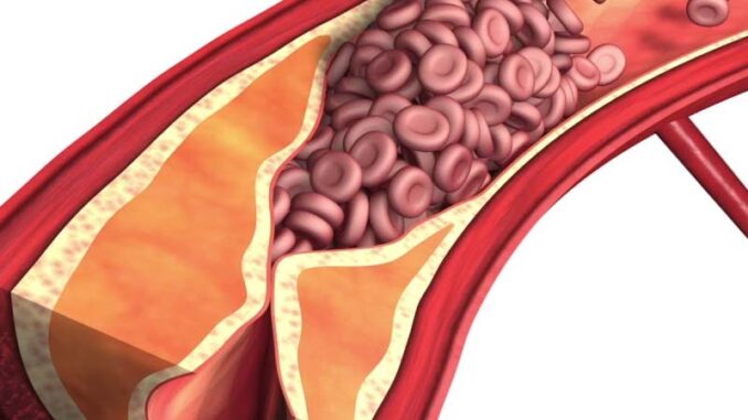 Miażdżyca tętnic jest chorobą zwyrodnieniowa wytwórczą o różnej etiologii. Prowadzi do uszkodzenia naczyń krwionośnych.