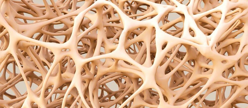 Osteoporoza